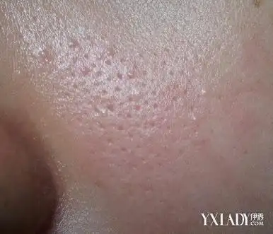 脸上毛孔大图片 脸部毛孔粗大怎么办