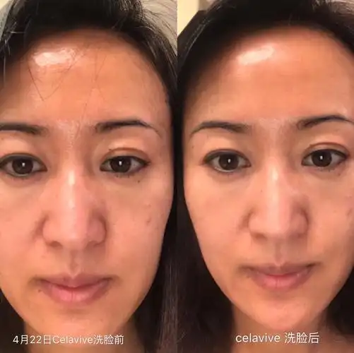 吃usana营养素,用celavive护肤品前后对比