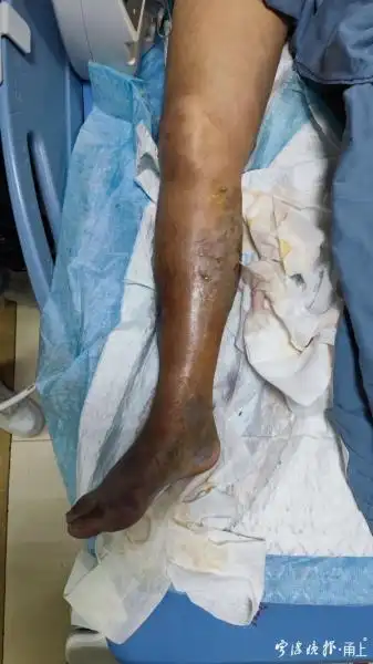 宁波阿姨海边玩一下 第四天右腿截肢 医生:近期连遇到三例