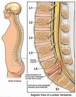 行ct检查示:腰4/腰5,腰5/骶1椎间盘突出,需住院进一步治疗.