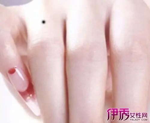 【图】右手背长痣是好是坏 解析手掌志的含义