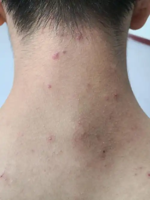 前胸后背头皮毛囊炎症状.