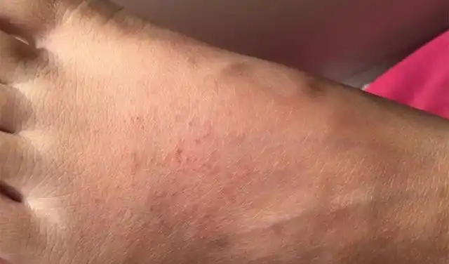 案例:女大学生患上脚气,因气味难闻引男友嫌弃,心理失衡酿悲剧