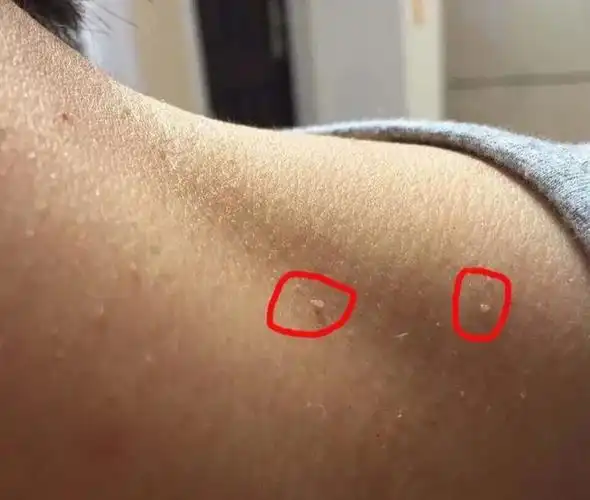 皮肤上的小肉球,小肉疙瘩是什么?医生:7种可能,有4种需要留意