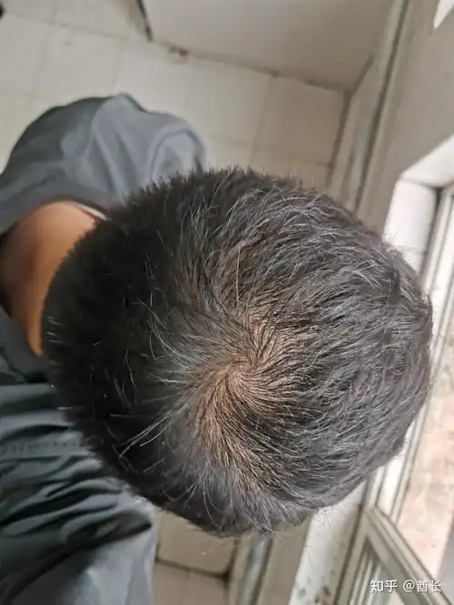 近况,昨晚发现枕头上全是头发人都麻了,但是作息不规律,估计压力大