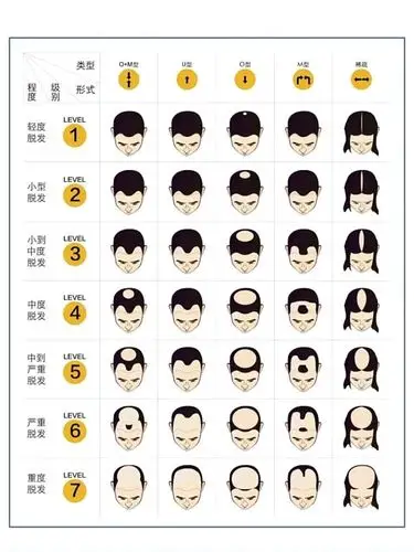 快!拿起你的镜子照着脱发等级图