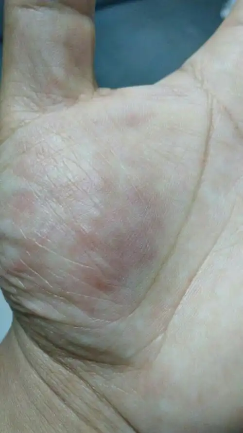 本人有乙肝病,左手起了很多非常痒的红色包,七八天左右就好,小的时候