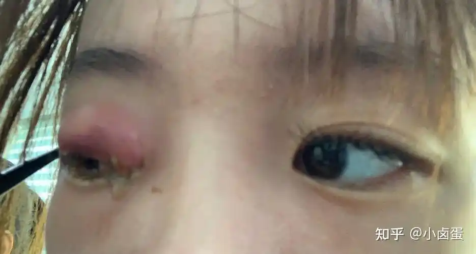 记录我的麦粒肿 - 知乎