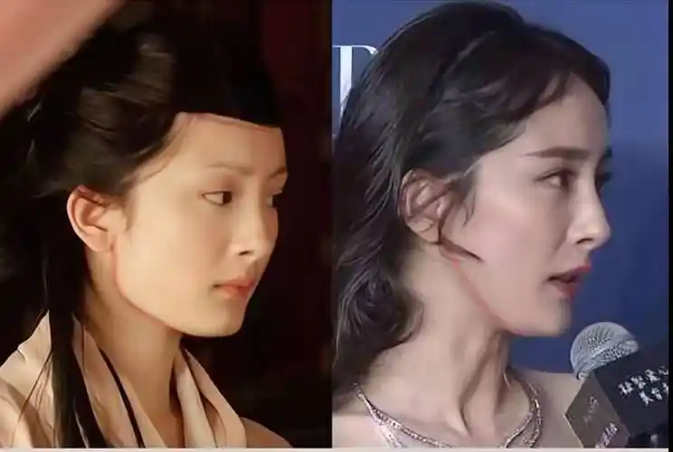 杨幂做完手术后,不仅形成了二次折角,下颌角也变得不流畅了.