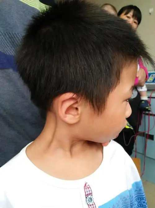 手术治疗先天性肌性斜颈的缺点有哪些?_歪头