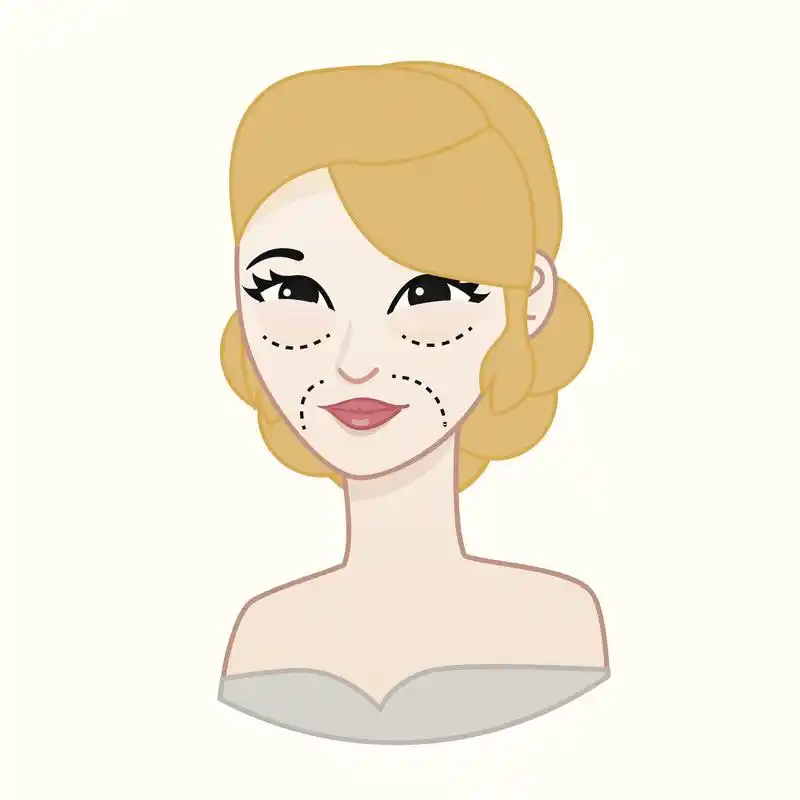 脂肪填充苹果肌术后有这4点必看的注意事项:#苹果肌下垂提升的最好