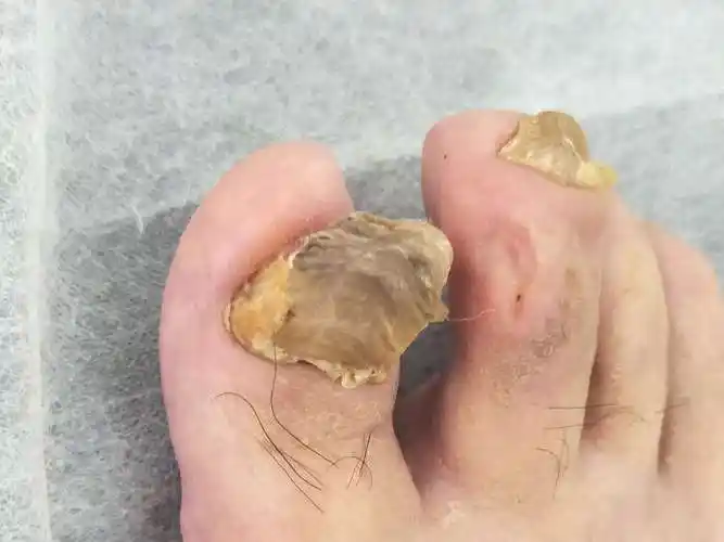 甲沟炎,小毛病,大困扰,有我在,帮您治!