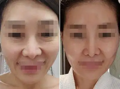 全脸脂肪填充有人后悔吗看看专业人士是怎么说的