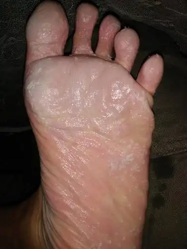 脚底很多洞洞 又臭