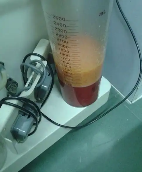 这是从身上抽出来的脂肪,看这大针管,看这血和脂肪,我去阿~~~挺让人