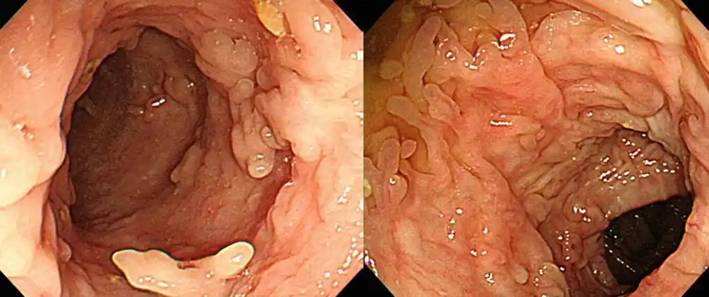 发现结肠息肉如何区分这11张图你一定要掌握