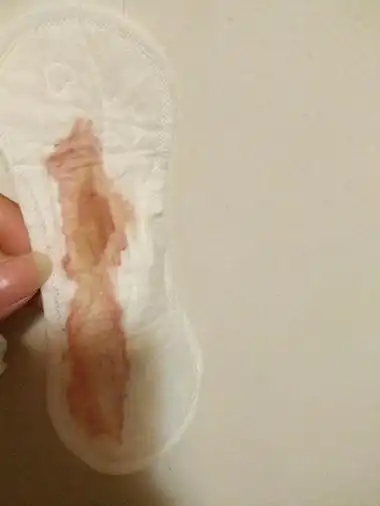 白带有血丝图片44