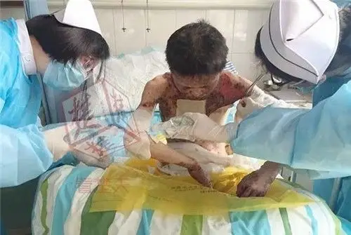 24岁妙龄少女患上怪病 罕见的淋巴结疾病全身溃烂