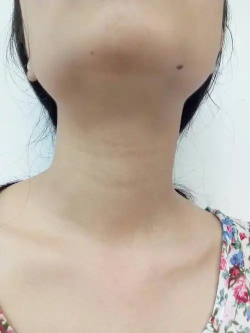 下巴长两个痣啥意思?