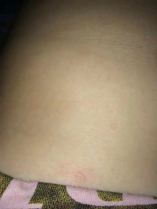 胸口前长了两个像被油溅了一样的两个小圆点 怎么回事啊 不痛不痒