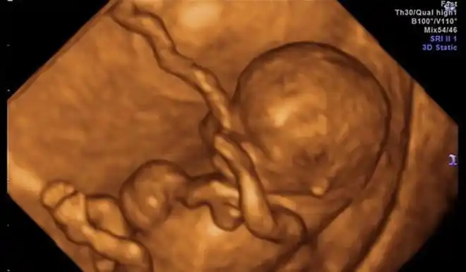 胎宝四维照片丑哭那生出来会不会丑看完之后孕妈就能放心了