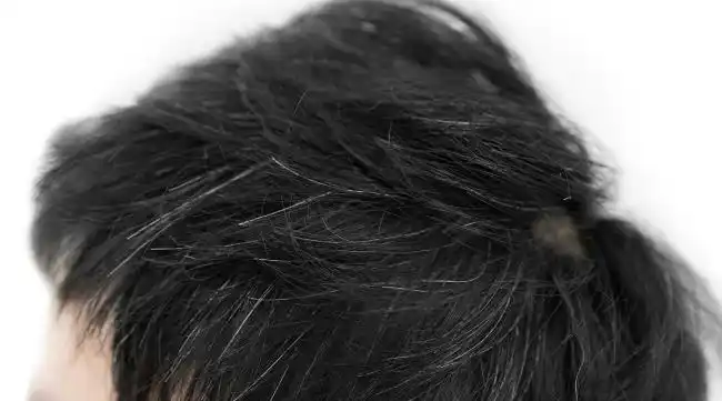 老年白发变黑发是怎么回事?