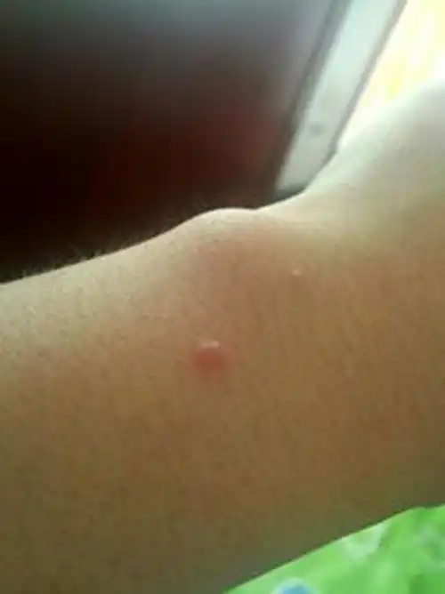 胳膊扁平疣轻微图片