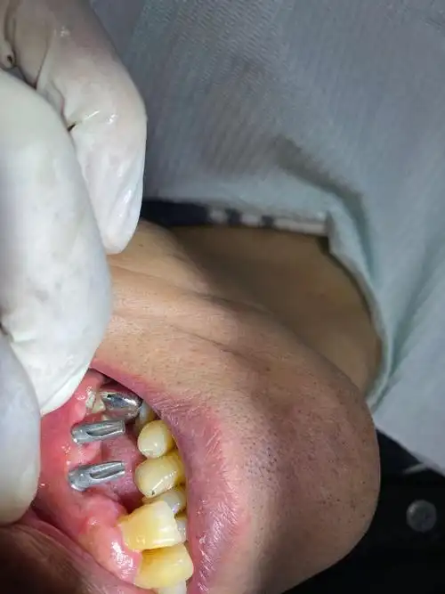 种植牙 - 春雨医生