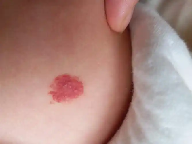 我宝宝刚出生两个多月,大腿侧面有一个红斑,显示为红色点状,刚出生时