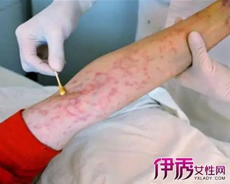 艾滋病急性期症状可以反复出现吗-精准抗艾-互联网艾滋病性病预防诊疗