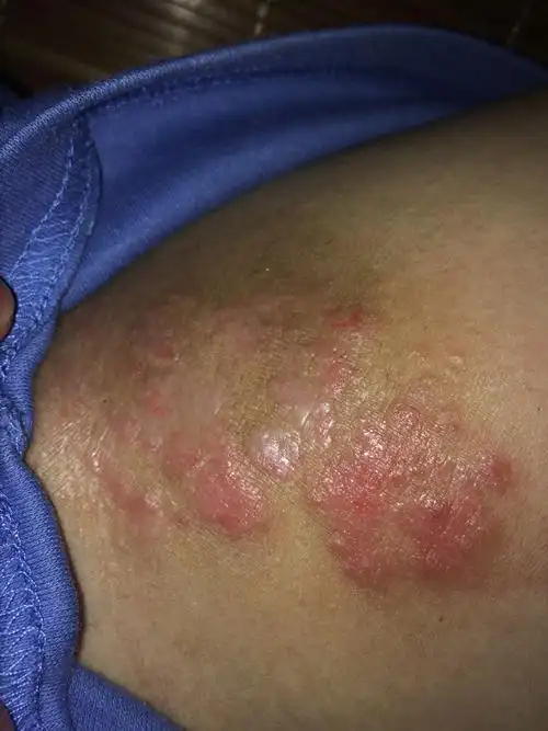 大腿两侧长了这些怎么办?