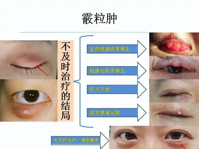 眼睑红又是怎么回事?用图解问题