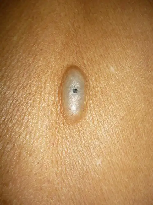 耳朵后边的皮脂腺囊肿图片