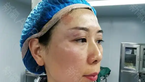 自体脂肪填充丰眼窝当天眼睛有点轻微的肿胀感眼部肌肤变得饱满紧致