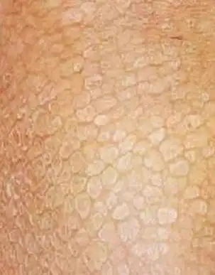 来讲鱼鳞病患者应忌虾,海鲜,酒,辛辣食物,中医以为虾,海鲜有腥发之性