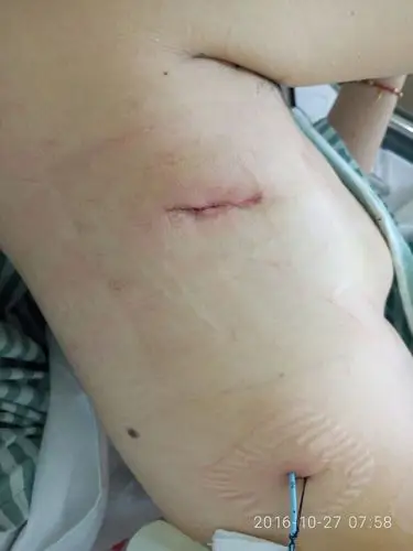 这是拔胸管后,拔arrow管前的照片