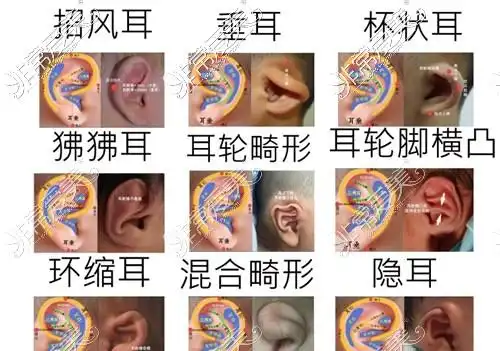 深圳有名耳朵形整形医院公布,耳朵矫正费用分享!-非常爱美