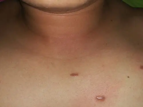 胸口不知道长什么东西硬硬,请问大家这是什么皮肤病?