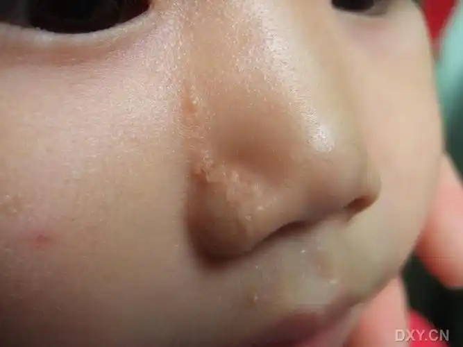 【病例讨论】面部疣状新生物 [病例帖]