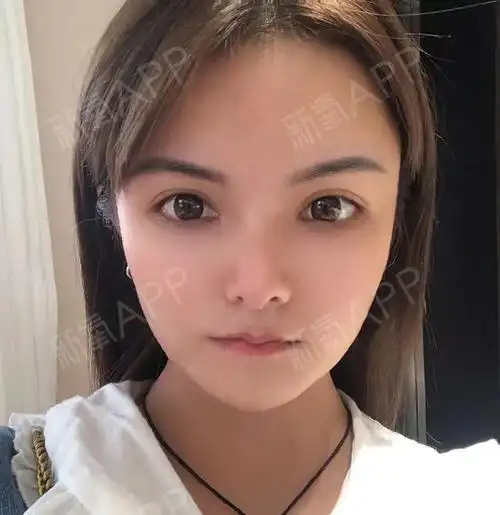 嘴唇薄玻尿酸丰唇玻尿酸注射后即刻效果,饱满红润!_圈子-新氧美容整形