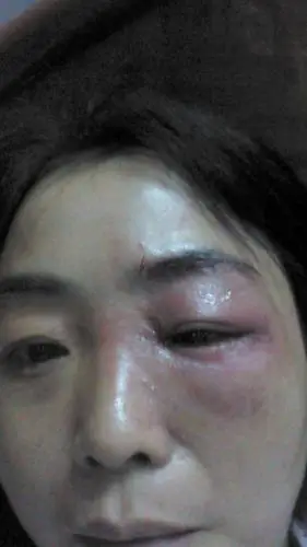 吃泡鸡爪左眼过敏又红又肿还痛怎么办