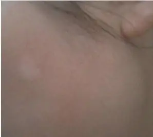 脸上发白的东西是什么皮肤病,是白癜风还是白斑,有点痒痒的,最近一个