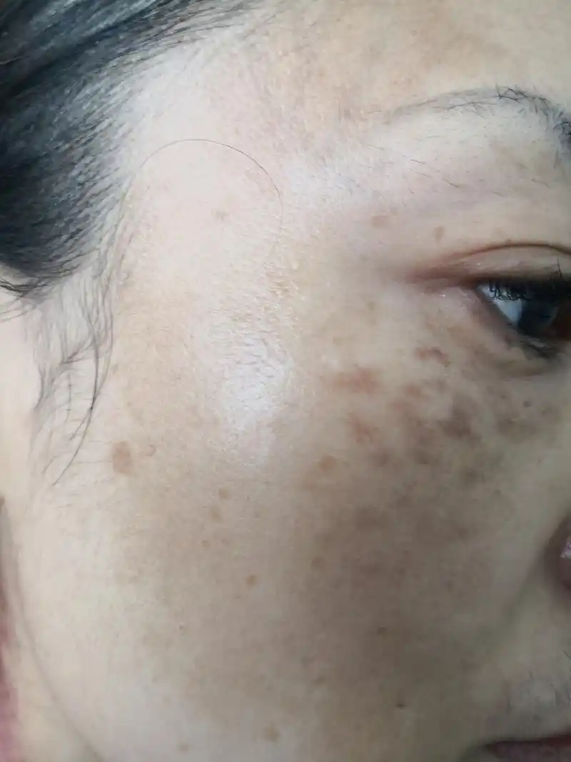 额头面颊弥漫性黄褐色斑片.考虑黄褐斑症状黄褐斑 需要系统治疗一段时