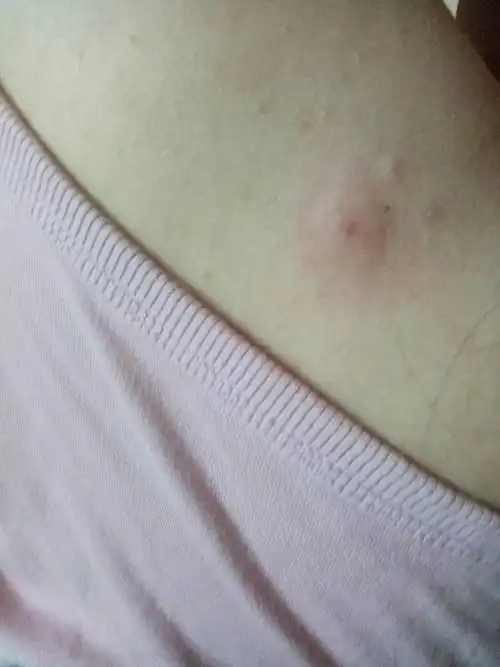 背上长了这样一个包大概是什么