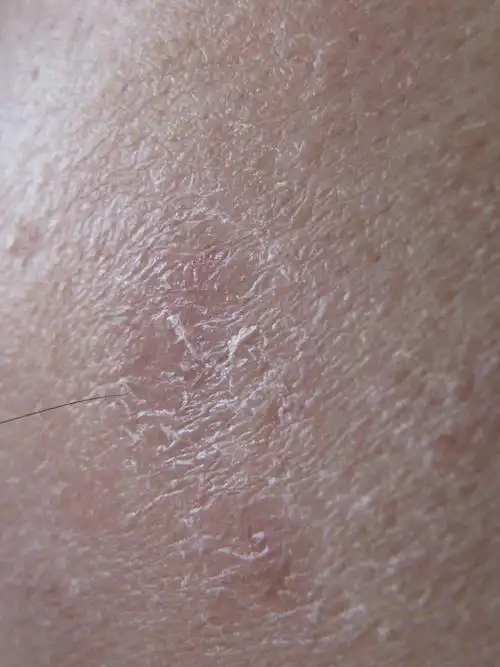 面部皮肤问题,见图