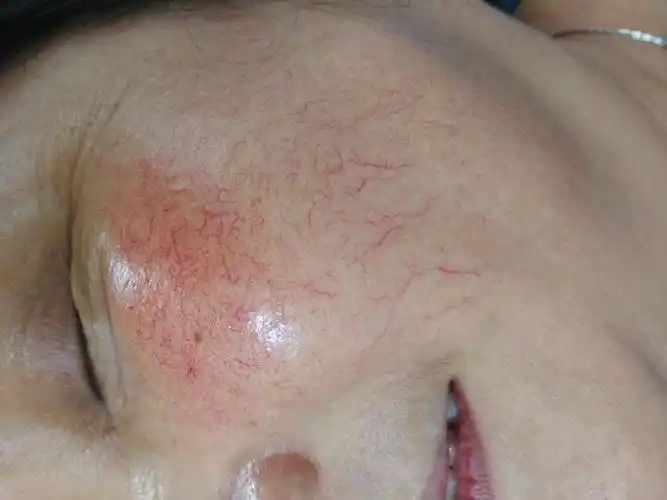 用药不当所致的红血丝 - 好大夫在线