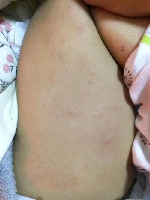 到医院检查说是湿疹,可能因为牛奶蛋白过敏引起的