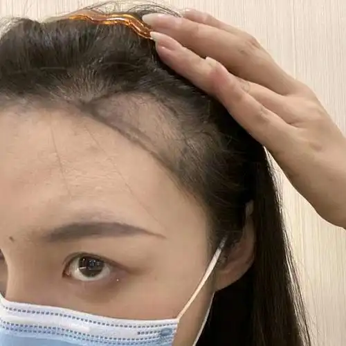 发际线过高,秃鬓角,整个人的颜值和气质都会下跌,每次想扎丸子头都是