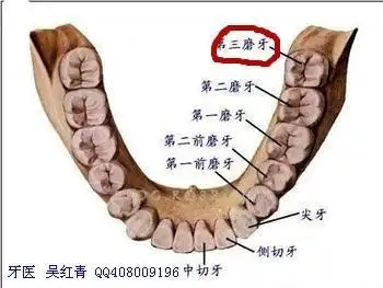 在我们口腔医学上专业的称之为-----第三磨牙,请看下图:下颌阻生智齿