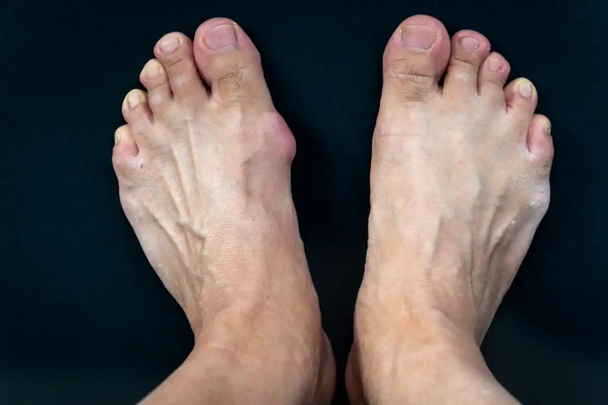 但是上了大学后,我进了校礼仪部,需要穿高跟鞋参加活动,我感觉拇外翻